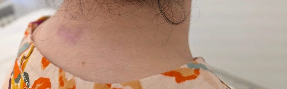 Nacken nach der dauerhaften Haarentfernung - glatte Haut