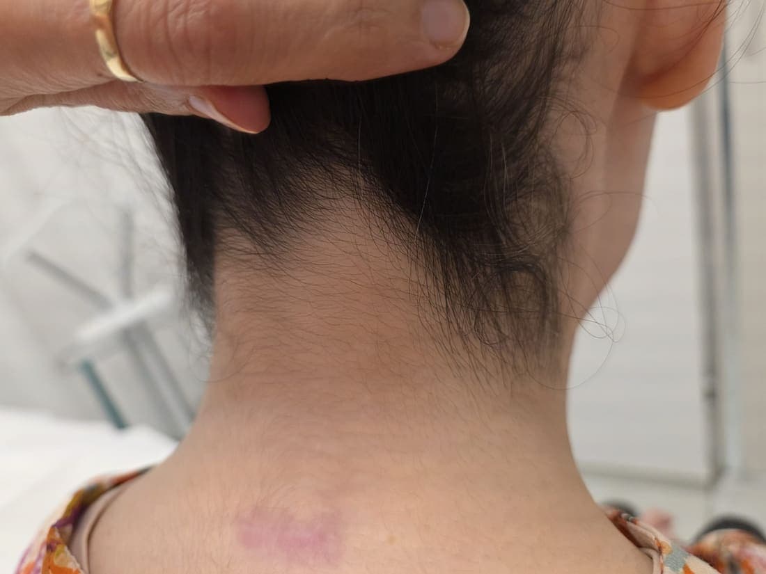 Dauerhafte Haarentfernung für Damen - echtes Behandlungsergebnis 1