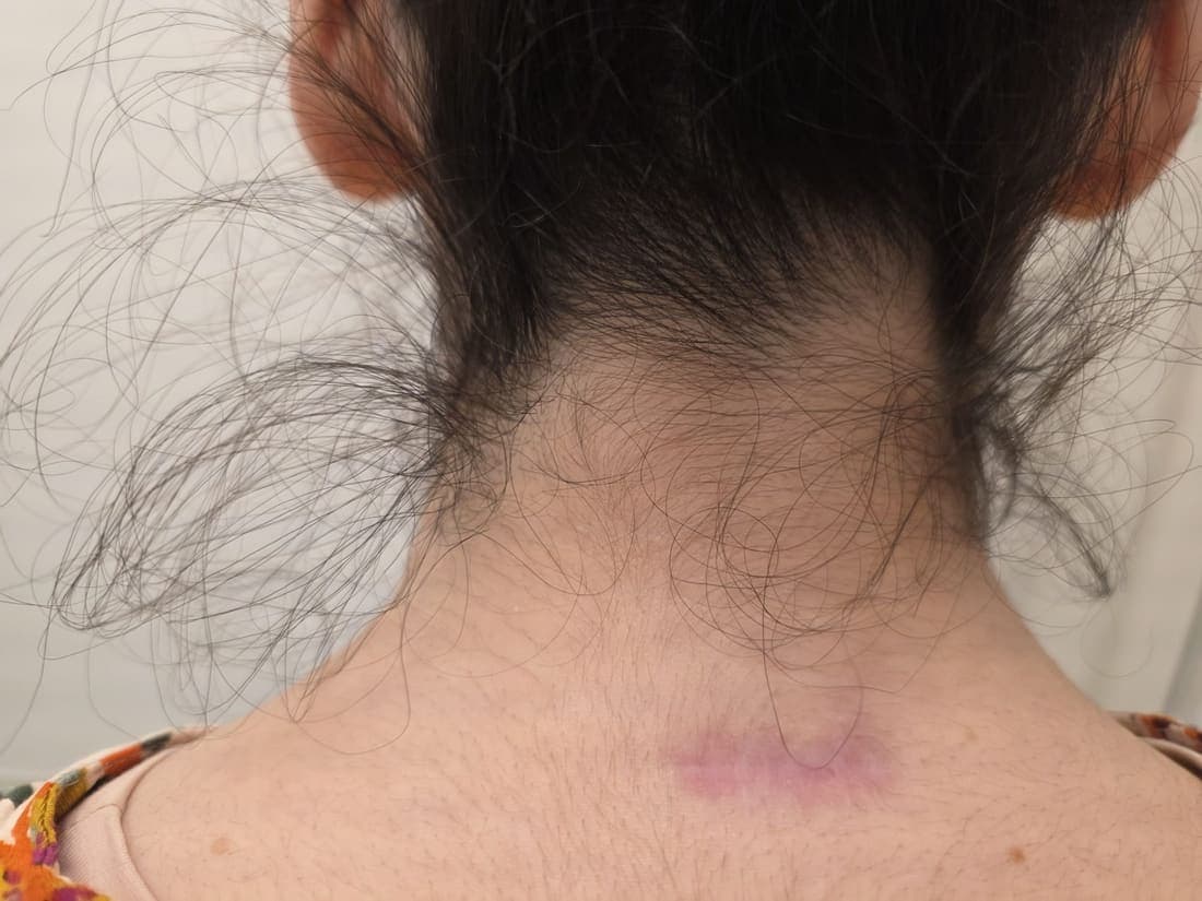 Dauerhafte Haarentfernung für Damen - echtes Behandlungsergebnis 2