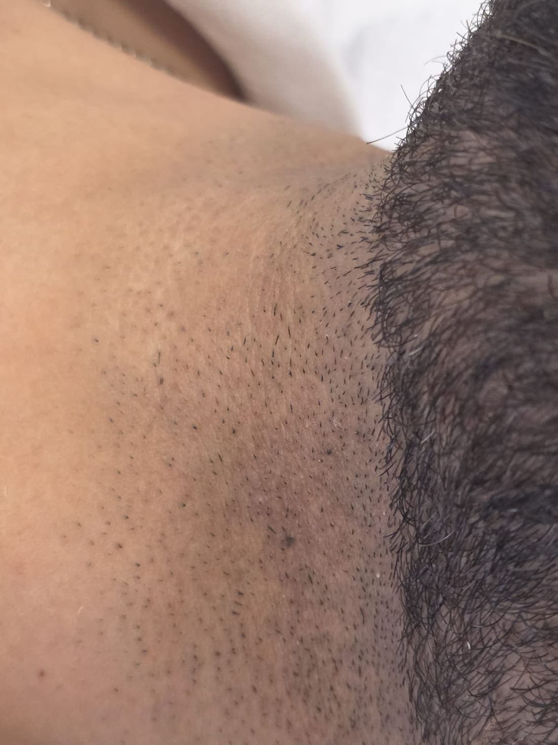 Dauerhafte Haarentfernung für Herren - echtes Behandlungsergebnis 2